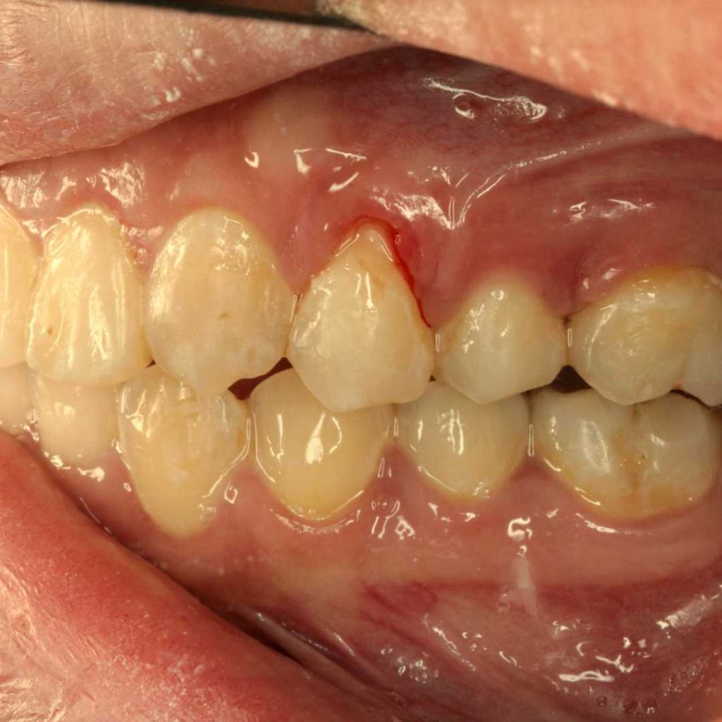 calgary dentist gum disease