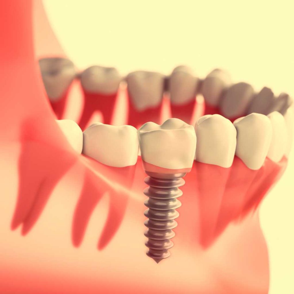 dentist calgary dental implants