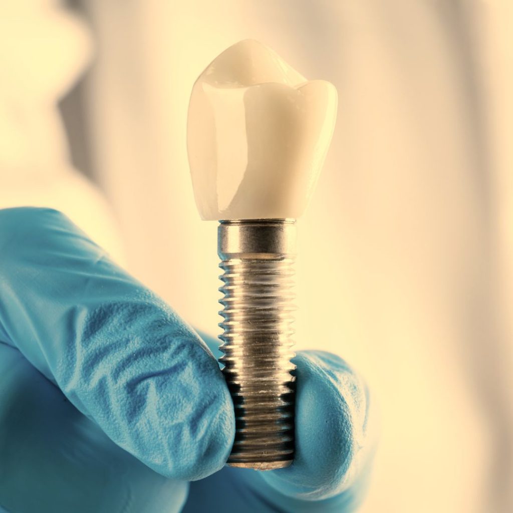 dental-implants-calgary-downtown