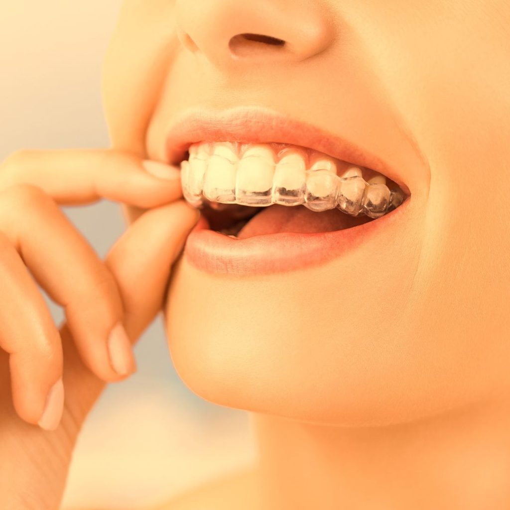 invisalign-dentist-calgary-downtown