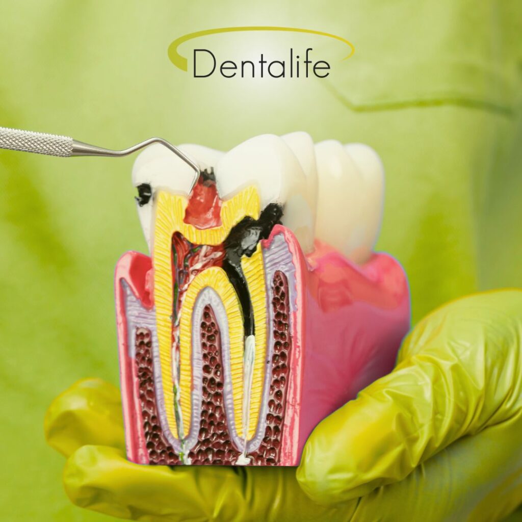 calgary-downtown-root-canal-dentist