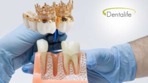 dental-crown-dentist-dentalife-calgary