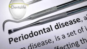 periodontal-disease-dentist-dentalife-calgary