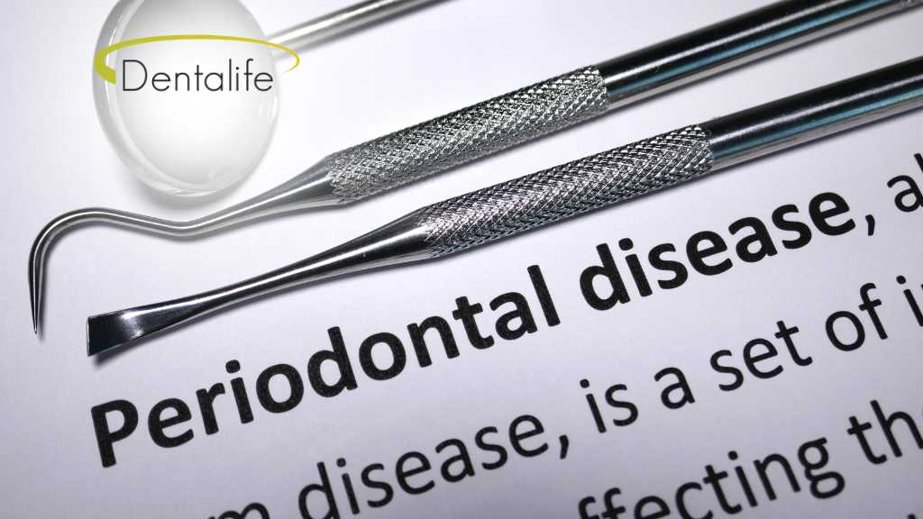 periodontal-disease-dentist-dentalife-calgary