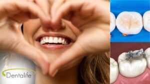 amalgam-vs-white-fillings-dentist-dentalife-calgary